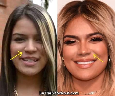 karol g nose job|Karol G Plastic Surgery Comparison Photos